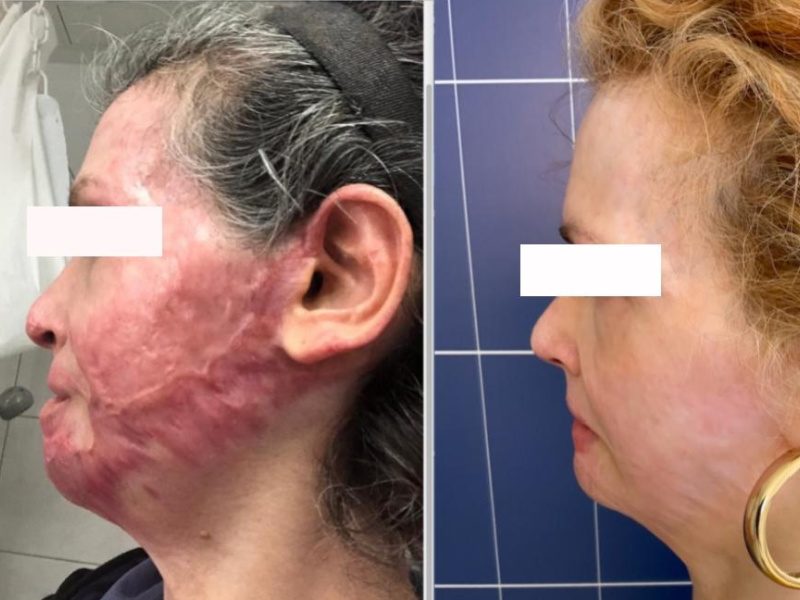 Eterna Health Stem Cell Burn Scar Treatment Before and After